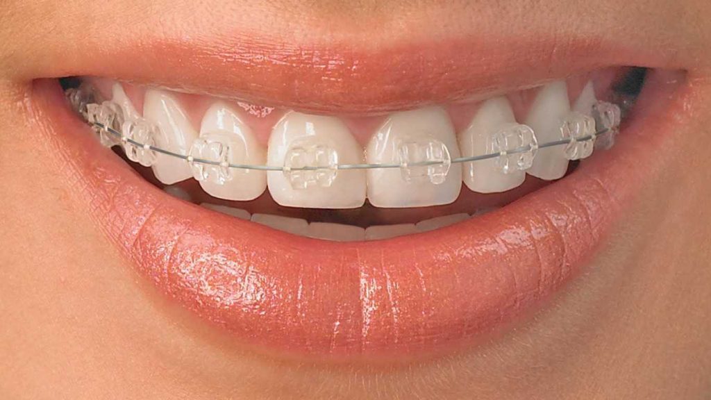 ¿Dientes Chuecos? – Clínica Dental Mydent Red Dental